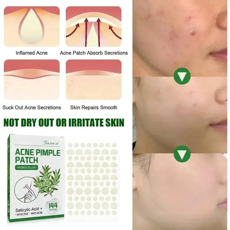 Overnight Acne Patches With Salicylic Acid For Clearer Skin