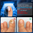 Multi Toenail Fungus Light Therapy Device Blue Light Phototherapy