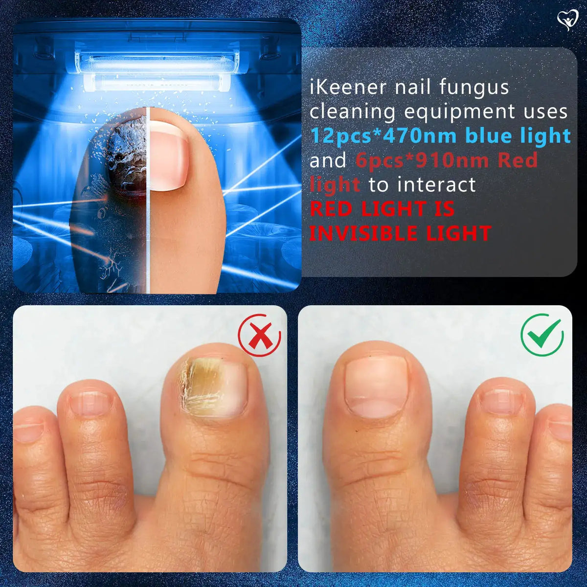 Multi Toenail Fungus Light Therapy Device Blue Light Phototherapy — product view 2