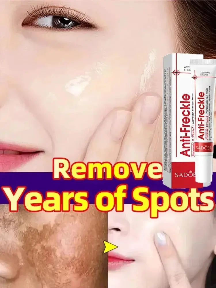 Whitening Freckle Cream Remove Dark Spots Anti Freckle Face Creams Niacinamide Fade Pigmentation Melasma Brighten Skin Care 20g
