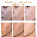 TRSTAY Whitening Freckles Cream for Melasma Dark Spots Brightening