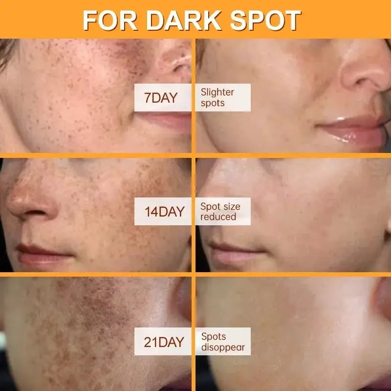Effective Whitening Freckles Face Cream Remove Melasma Dark Spots Fade Pigmentation Acne Scars Moisturizing Brighten Beauty Care