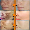 Whitening Cream for Women Fade Melasma