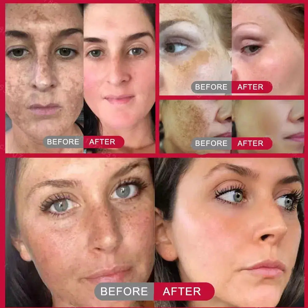 Powerful Spot-removing Whitening Cream Brighten Skin Fast Eliminates Melanin Pigmentation Melasma Dark Spots Korean Skin Care