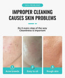 PWYUMAN Acne Cream for Acne Prone Skin