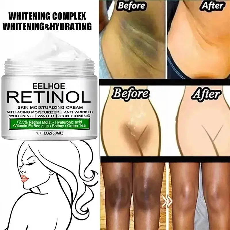 Body Whitening Cream Dark Skin Armpit Lightening Intimate Areas Underarm Bleaching Private Parts Whiten Cream Body Lotion Beauty