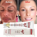 Brightening Melasma Cream for All Skin