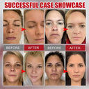 Whitening Freckle Face Cream for Melasma