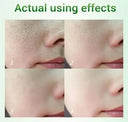 Salicylic Acid Pore Shrinking Cream For Large Pores Blackhead Removal Tighten
