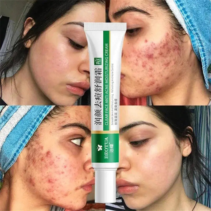 Acne Treatment Gel Herbal Whitening Moisturizing Solution