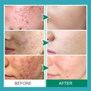 PWYUMAN Acne Cream for Acne Prone Skin