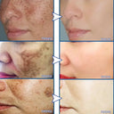 Whitening Cream for Women Fade Melasma