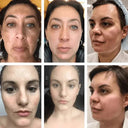 Freckle Cream For Brighter Skin