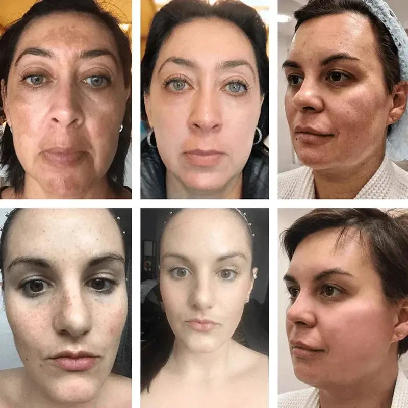 Astragalus Whitening Freckles Face Cream Remove Dark Spots Melasma Lighten Melanin Acne Scars Anti-aging Brighten Skin Care 55g