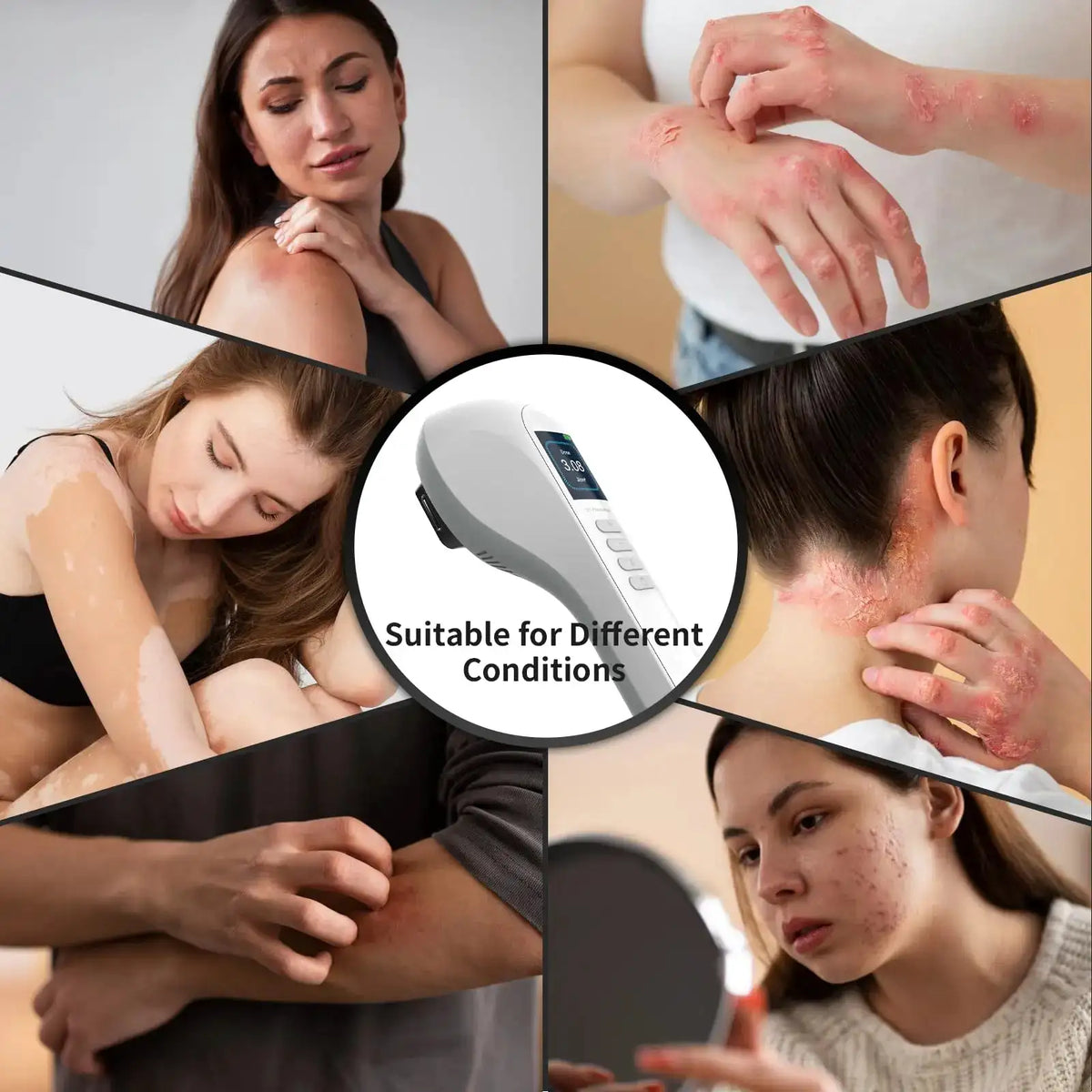 UV Light for Vitiligo Handheld UVB Phototherapy Lamp with LCD — product view 1