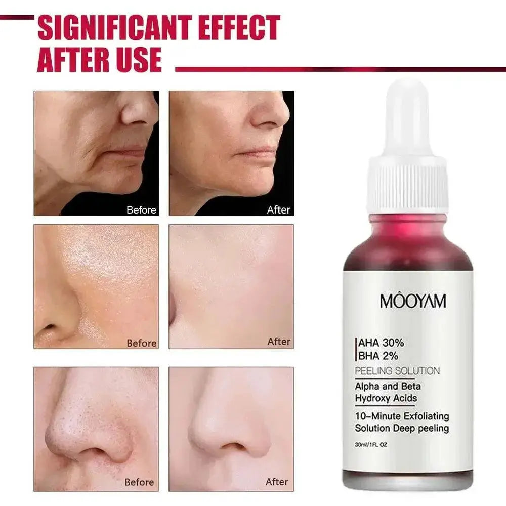 New Face Peeling Solution AHA 30 Percent BHA 2 Percent Serum
