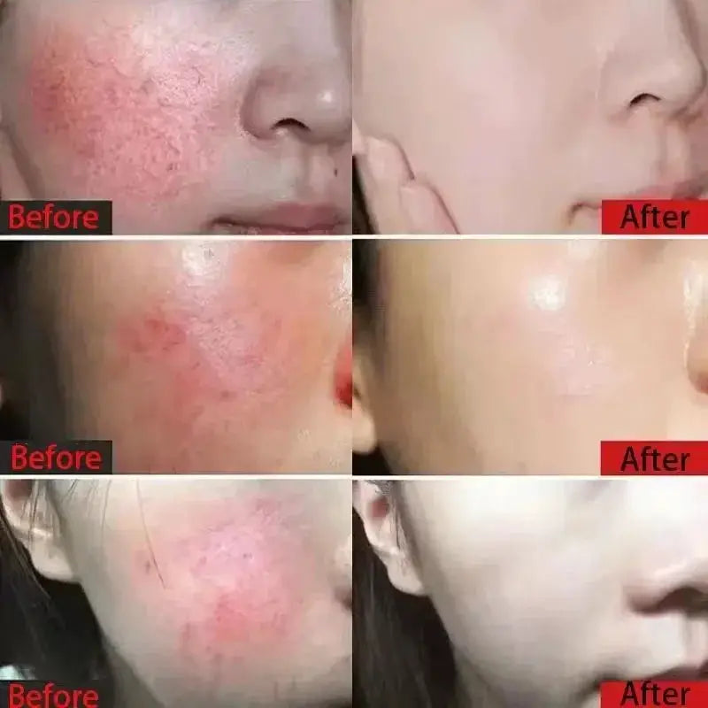 Facial Redness Repair Cream Improve Sensitive Skin Dryness Hydrating Sooth Lotion Removal Rosacea Day Night Korean Cosmetics