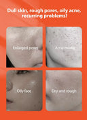Oil Control Acne Cream for Clear Skin