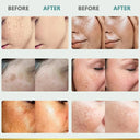 Whitening Freckle Face Cream for Melasma