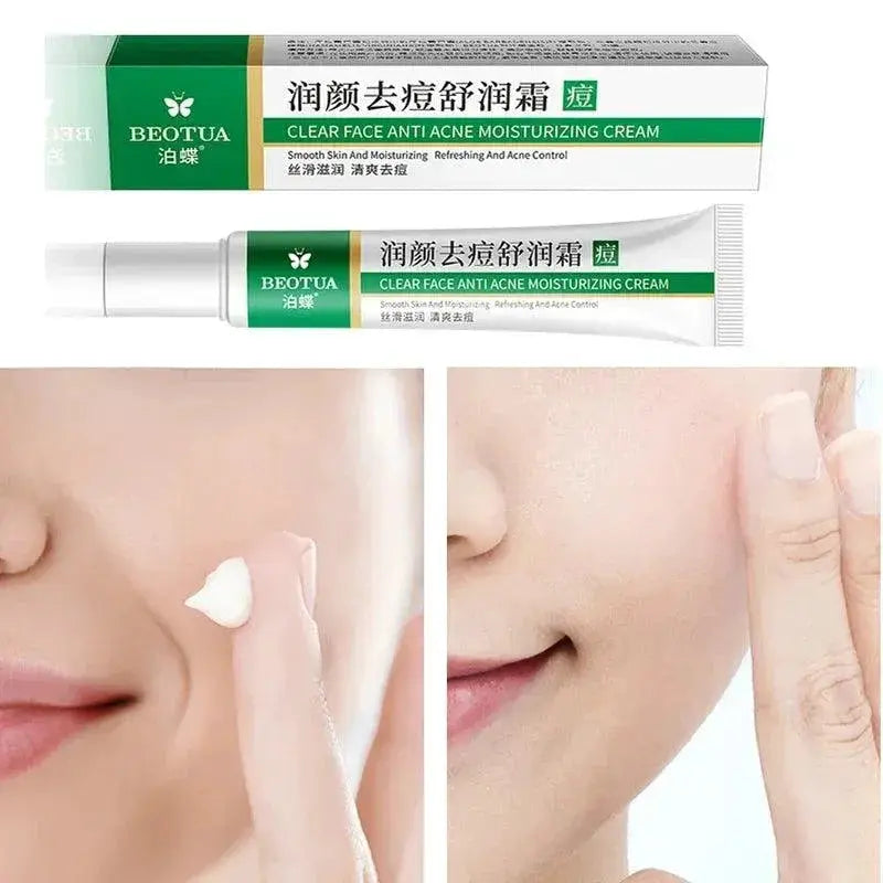 Acne Treatment Gel Herbal Whitening Moisturizing Solution