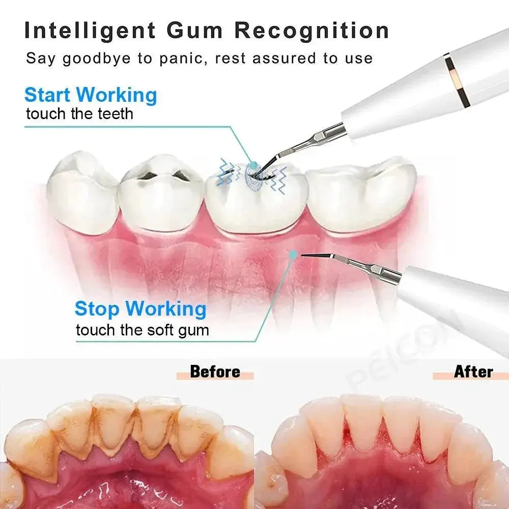 Ultrasonic Dental Stain Remover for Bright Smiles Today