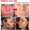 Freckle Cream For Brighter Skin