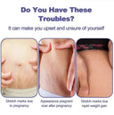 Stretch Mark Removal Cream for New Moms