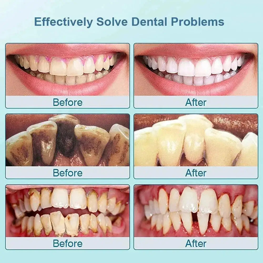 Ultrasonic Dental Stain Remover for Bright Smiles Today