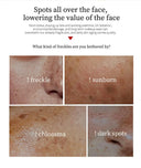 Whitening Freckle Face Cream for Melasma