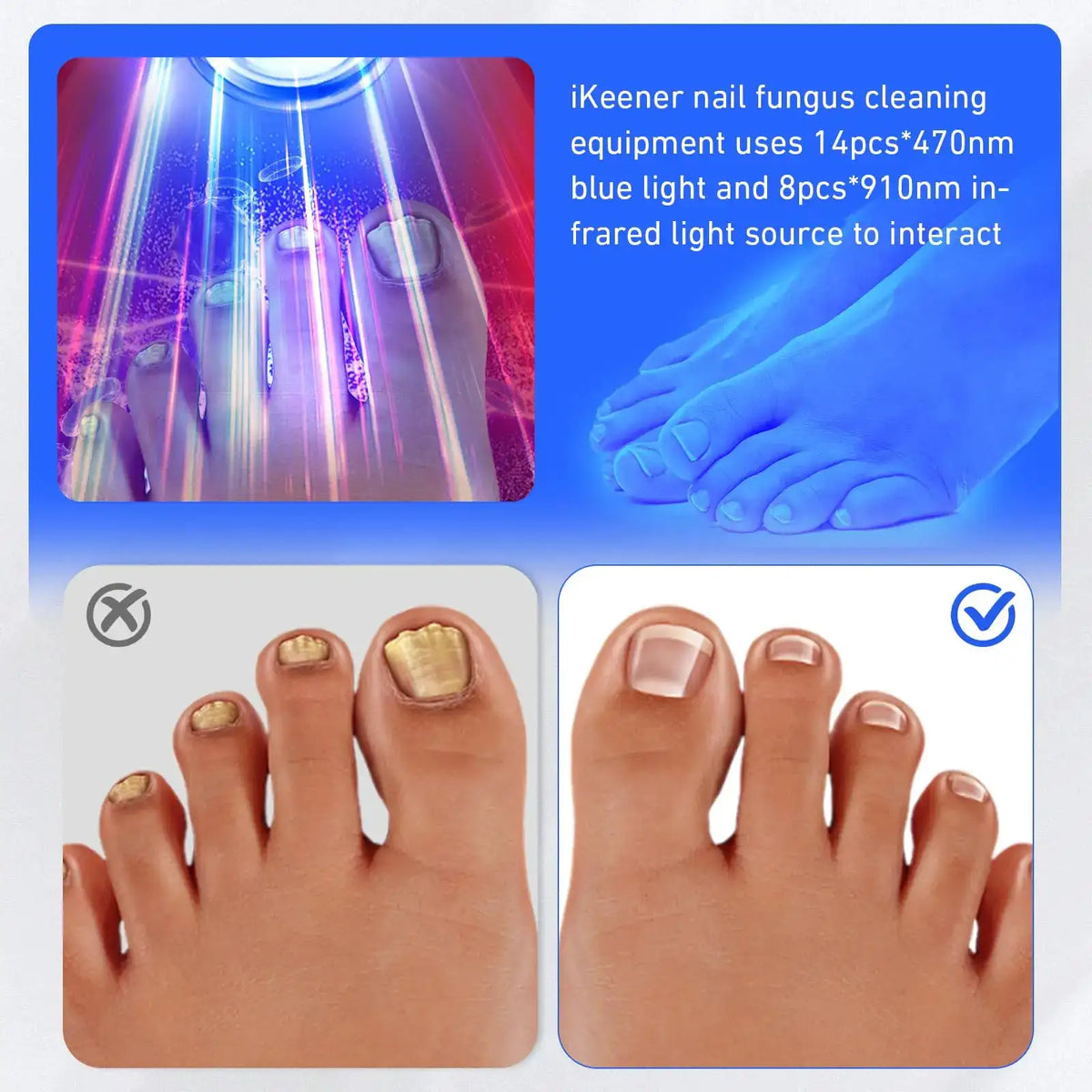 Wireless Nail Fungus Cleaning Device for Toenails & Fingernails — product view 3