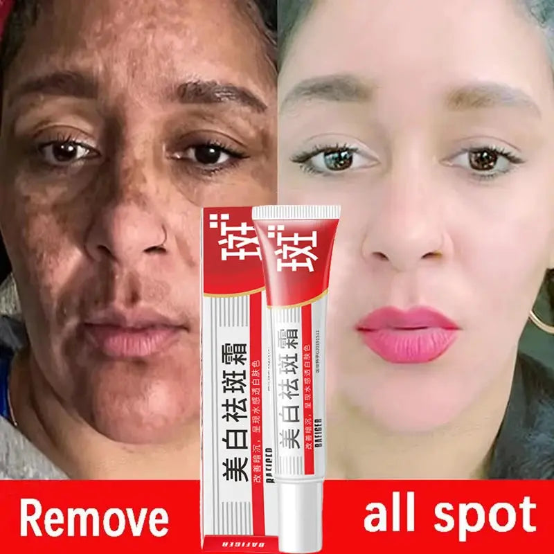 Effective Whitening Freckles Face Cream Remove Melasma Dark Spots Fade Melanin Acne Scars Anti-aging Brighten Repair Skin Care