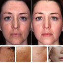 Whitening Cream for Women Fade Melasma
