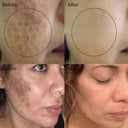 Whitening Freckle Face Cream for Melasma