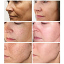 Whitening Freckle Face Cream for Melasma