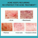 PWYUMAN Acne Cream for Acne Prone Skin