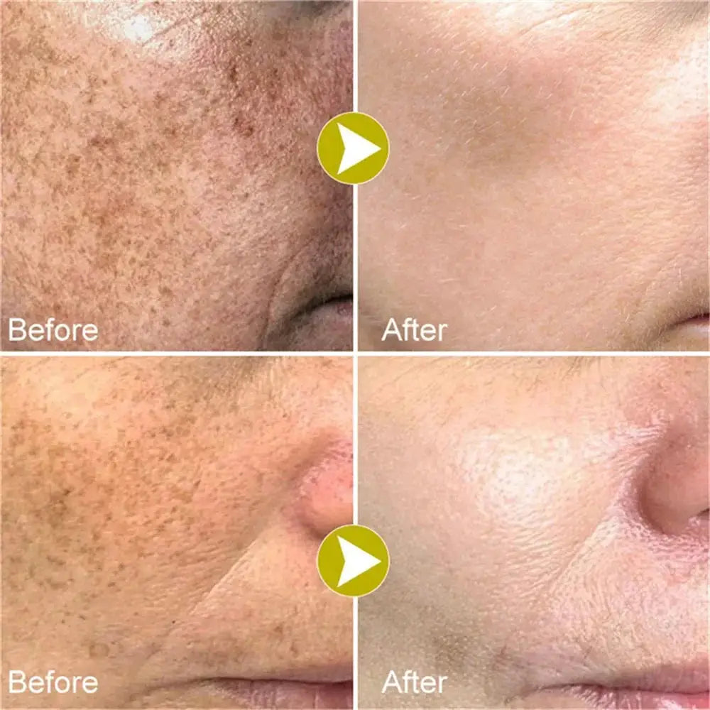Effective Whitening Freckles Face Cream Remove Melasma Dark Spots Fade Melanin Acne Scars Anti-aging Brighten Repair Skin Care