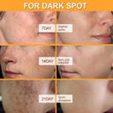 Whitening Cream for Women Fade Melasma