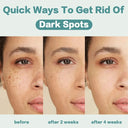 Whitening Freckle Face Cream for Melasma