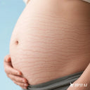 Stretch Mark Removal Cream for New Moms