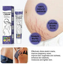 Stretch Mark Removal Cream for New Moms