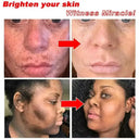 Whitening Cream for Women Fade Melasma