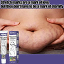 Stretch Mark Removal Cream for New Moms