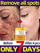 Freckle Cream For Brighter Skin