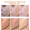 TRSTAY Whitening Freckles Cream for Melasma Dark Spots Brightening
