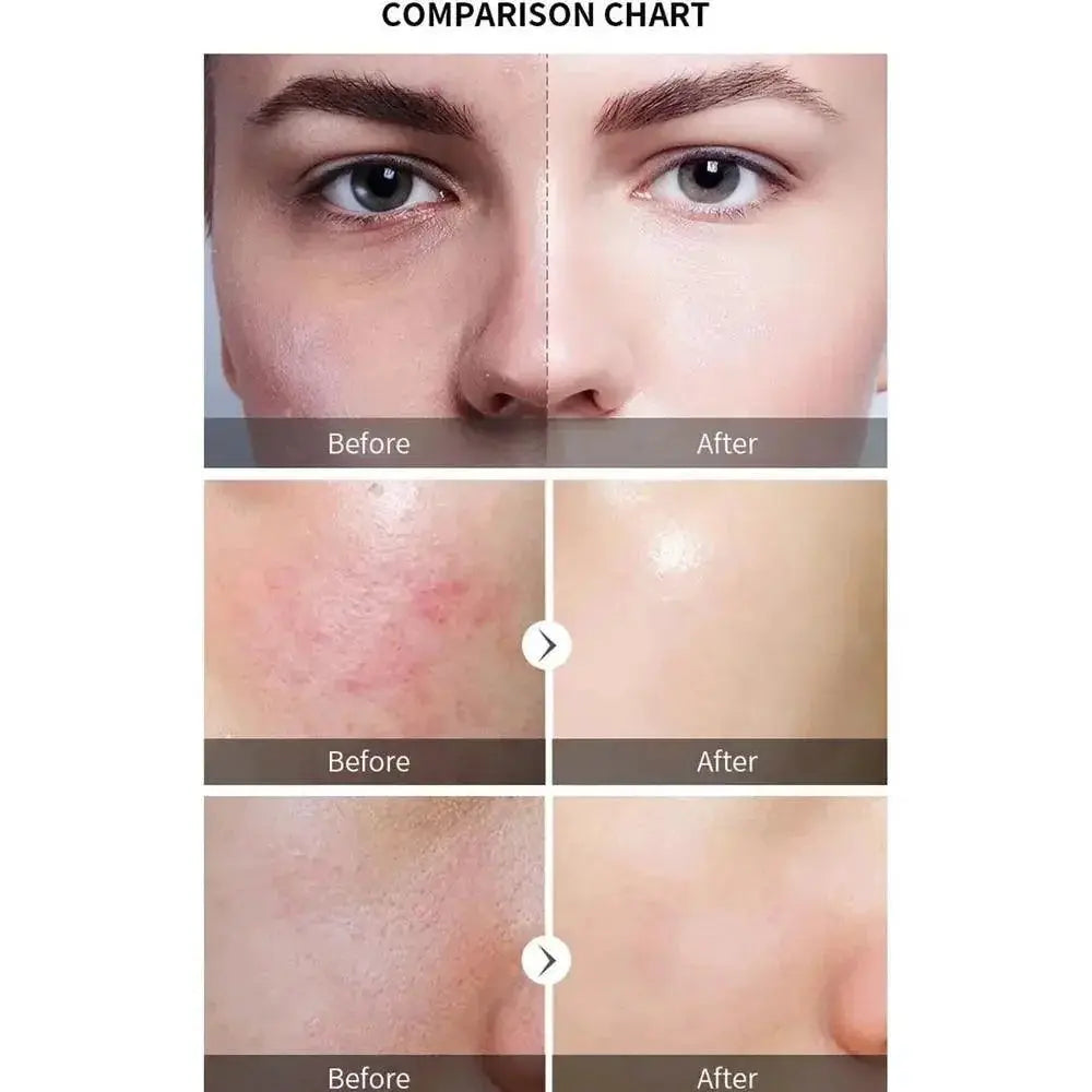 New Face Peeling Solution AHA 30 Percent BHA 2 Percent Serum