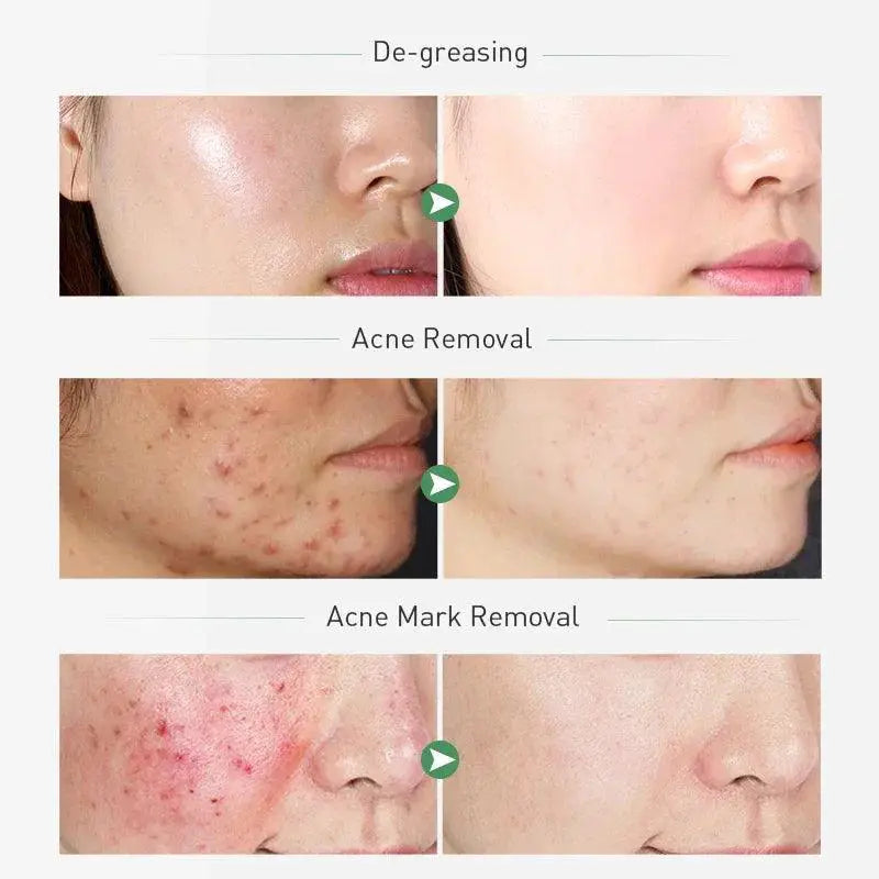 Tea Tree Acne Care Set Pimple Patch Kit For Clear Skin