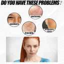 Brightening Melasma Cream for All Skin