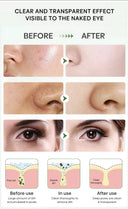 Acne Mask for Acne Prone Skin Pore Care
