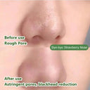Acne Mask for Acne Prone Skin Pore Care