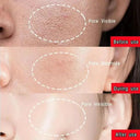 Acne Mask for Acne Prone Skin Pore Care